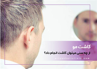 سن مناسب برای کاشت مو چقدر است؟