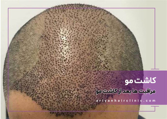 مراقبت های بعد از کاشت مو