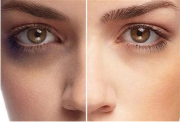 رفع تیرگی دور چشم