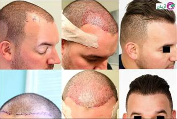 the best country for hair transplant