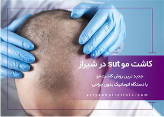 کاشت مو sut در شیراز