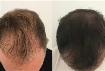 Micro Scalp/ Micro pigmentation