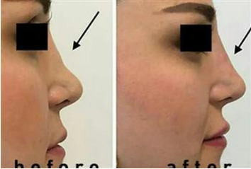 مزوتراپی بینی