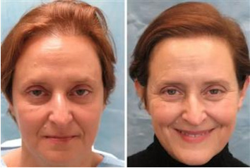 کاشت مو در خانم ها