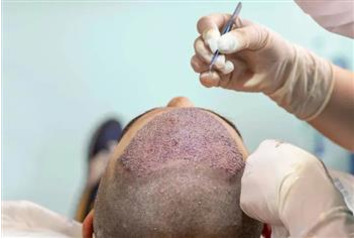أهم المعلومات عن زراعة الشعر في شيراز