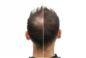 کاشت مو به روش SUT (اس یو تی)