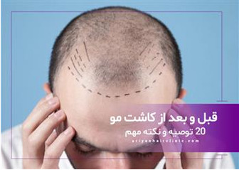 11 نکته مهم قبل از کاشت مو