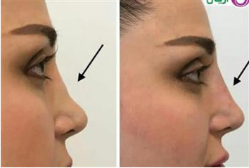 میزوثیرابي الأنف في کلینیک آریان