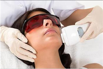 لیزر الشعر الزائد