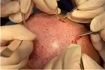 قبل و بعد از کاشت مو به چه مواردی توجه کنیم؟