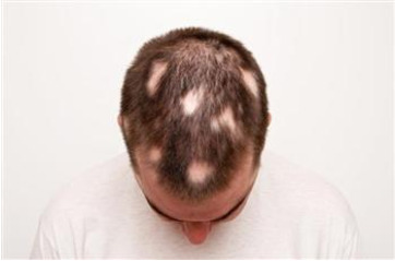 ریزش مو سکه ای یا آلوپسیا آره آتا چیست؟