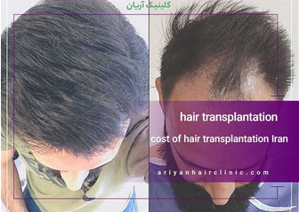 Price and cost of hair transplantation in Shiraz, Iran