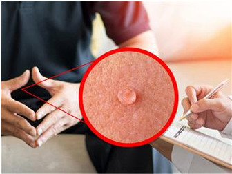 همه چیز درمورد زگیل تناسلی | علائم، دلایل و راه‌های درمان آن