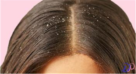 علت ایجاد شوره سر چیست و چگونه می‌توان آن را رفع کرد؟