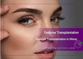 Eyebrow Transplantation in Shiraz