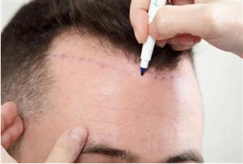 خط نمو الشعر فی منطقه الراس الامامیه