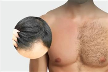 کاشت مو به روش BHT (بی اچ تی)