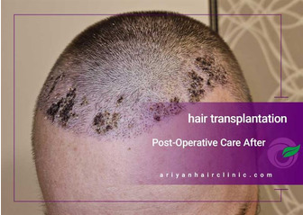 Post-Operative Care After Hair Transplantation