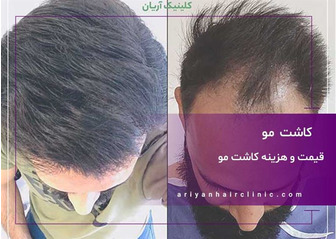 قیمت و هزینه کاشت مو