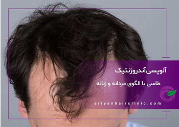طاسی با الگوی مردانه و زنانه