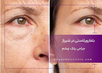 بلفاروپلاستی | جراحی پلک چشم