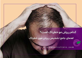 کدام ریزش مو خطرناک است؟