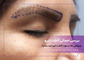 بررسی اجمالی جراحی کاشت ابرو
