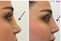 Nose beauty operation without surgery