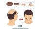Follicular Unit Transplantation