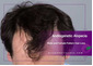 Androgenetic Alopecia