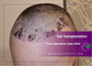 Post-Operative Care After Hair Transplantation