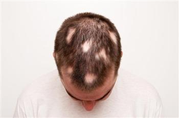ریزش مو سکه ای یا آلوپسیا چیست؟