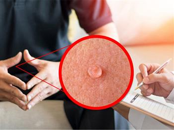 همه چیز درمورد زگیل تناسلی | علائم، دلایل و راه‌های درمان آن