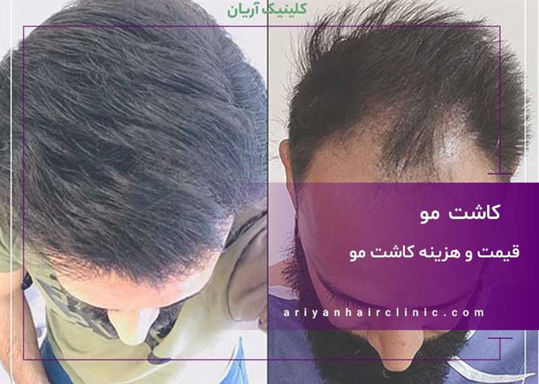 قیمت و هزینه کاشت مو