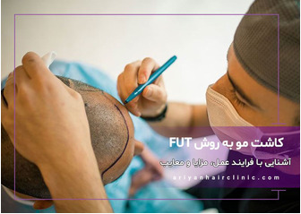 کاشت مو به روش FUT (اف یو تی)
