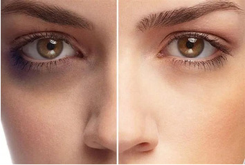 رفع تیرگی دور چشم