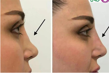 Nose beauty operation without surgery