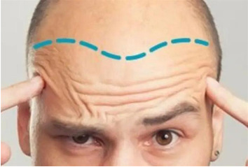  ریزش مو پس از کاشت مو !