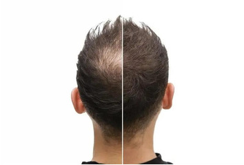 کاشت مو به روش SUT (اس یو تی)