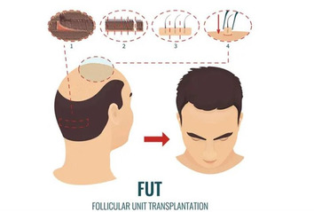 Follicular Unit Transplantation