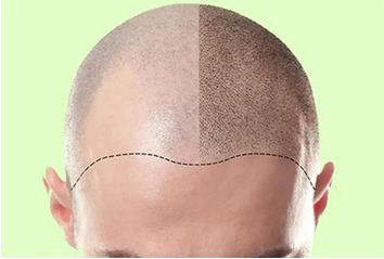 Preoperative recommendations