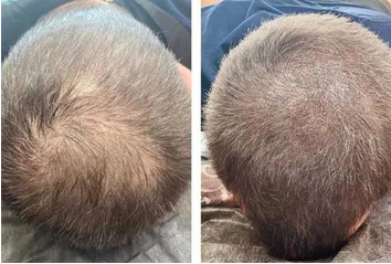 7 روش کاشت مو در ایران