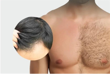 کاشت مو به روش BHT (بی اچ تی)