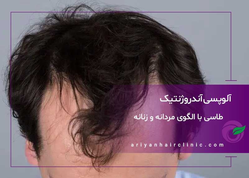 آلوپسی آندروژنتیک | طاسی با الگوی مردانه و زنانه