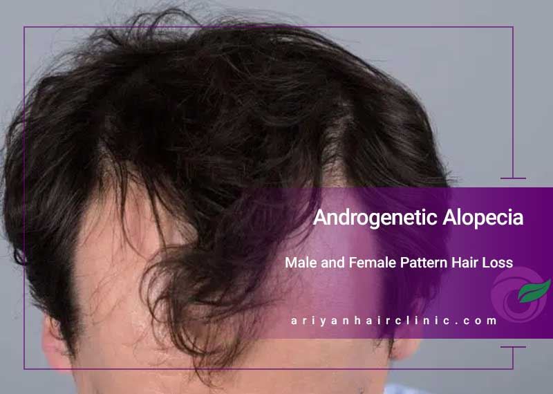 Androgenetic Alopecia | Male and Female Pattern Hair Loss