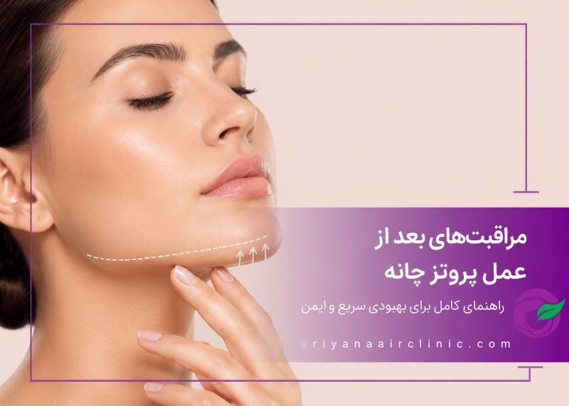 مراقبت‌های بعد از عمل پروتز چانه