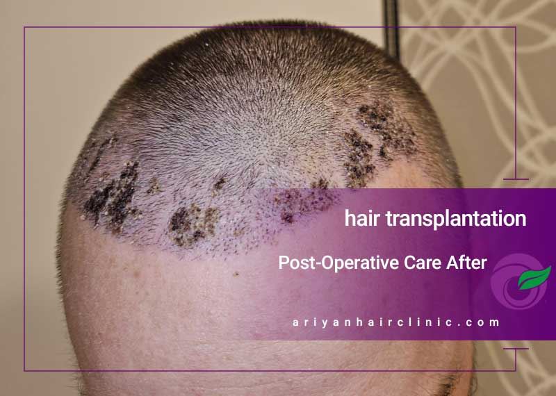 post hair transplant care