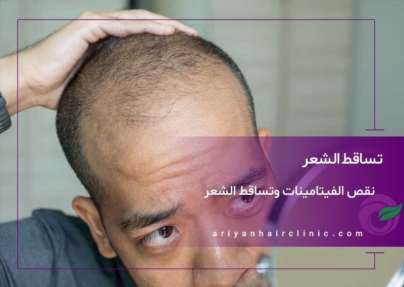 نقص الفيتامينات وتساقط الشعر | علاج تساقط الشعر وخدمات عيادة آريان
