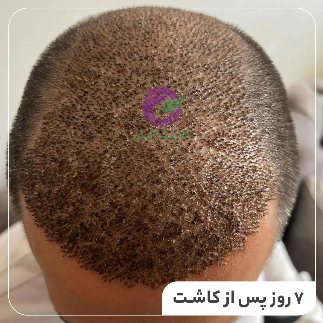 بهترین متخصص کاشت مو در شیراز